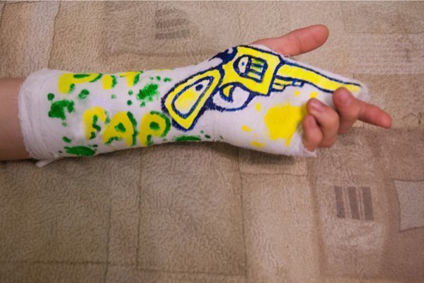 Разрисованный гипс на ноге