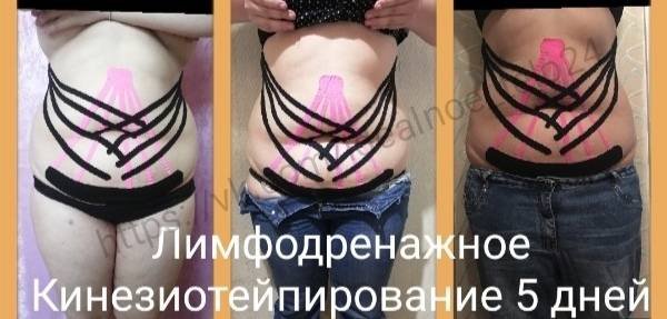 Тейпирования живота схемы