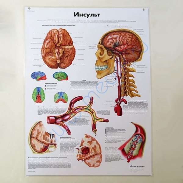 Плакат как распознать инсульт
