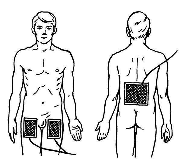 Лекарственный электрофорез схема