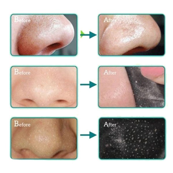 Очищение пор лица от черных точек