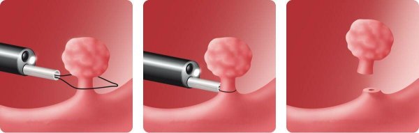 Гиперплазия эндометрия классификация