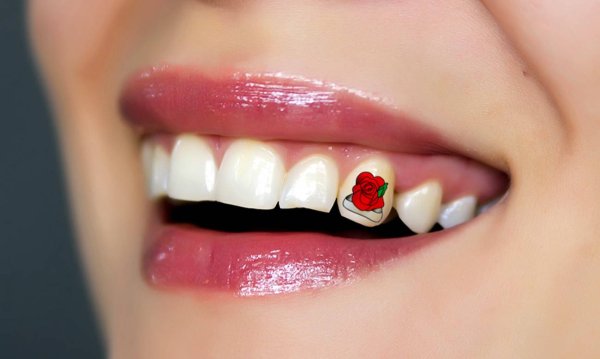 Украшение зубов скайсами