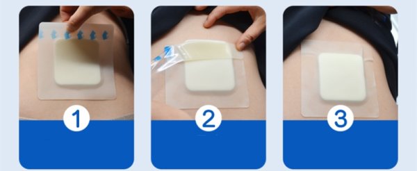 Повязка гидроколлоидная для РАН