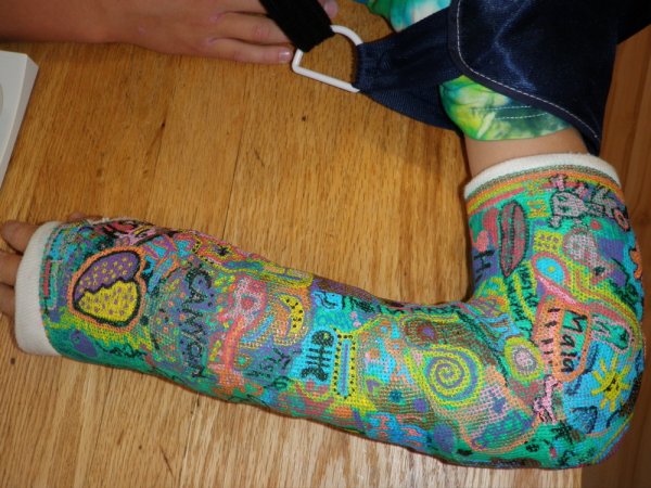 Раскрашенный гипс на руке