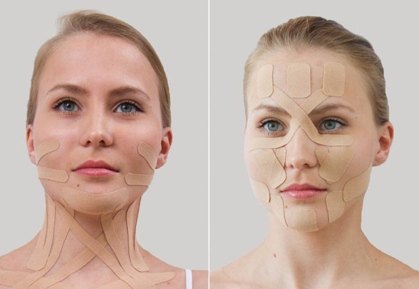 Тейпирование от брылей