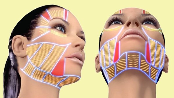 Тейпирование комков Биша