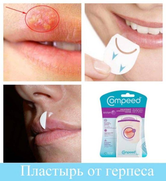 Пластыри Compeed для герпеса