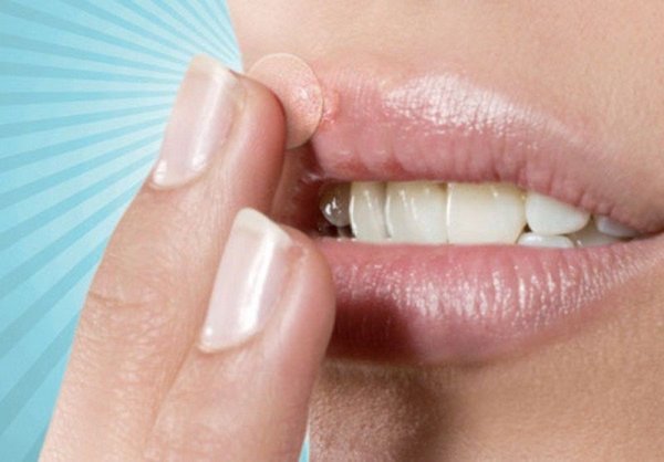 Маскирующий пластырь от герпеса