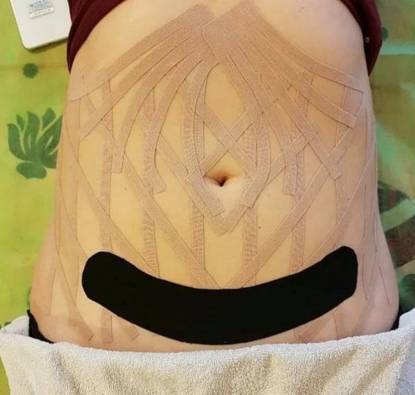 Лимфодренажное тейпирование живота и боков