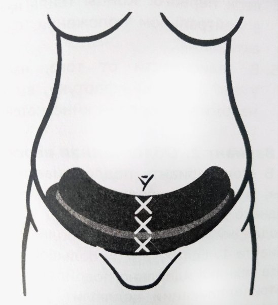 Тейпирование живота для похудения схема