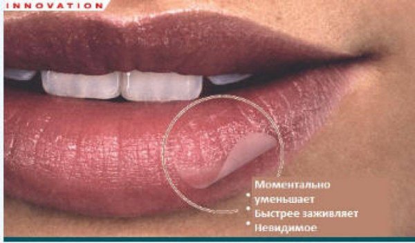 Пленка от простуды на губах