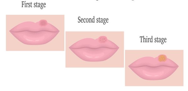 Противовирусные препараты герпес на губах