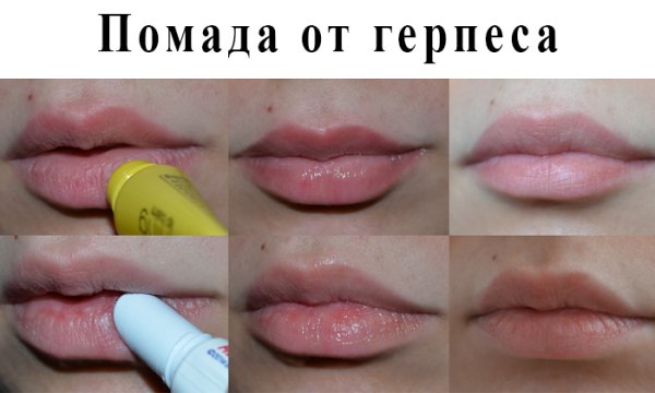 Заразен ли герпес для окружающих