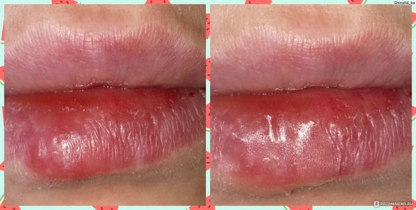 Мазь от болячек на губах