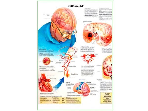 Плакаты по неврологии