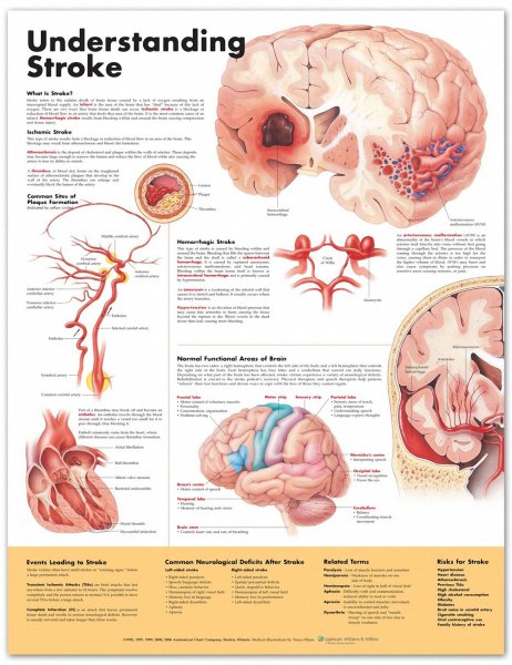 Профилактика инсульта плакат