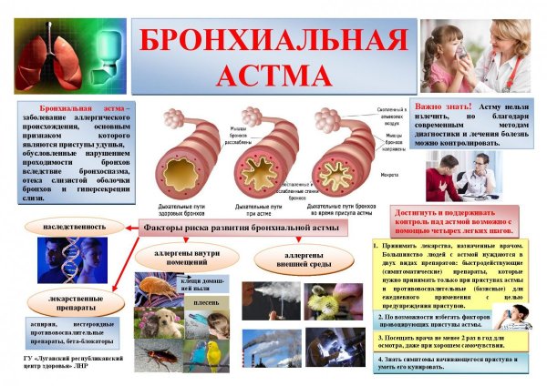 Санбюллетень профилактика бронхиальной астмы
