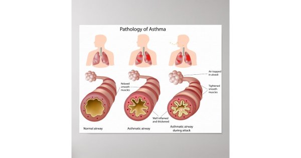 Профессиональная бронхиальная астма плакат