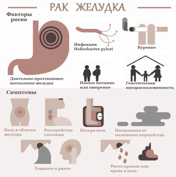 Опухоль желудка симптомы на ранней стадии