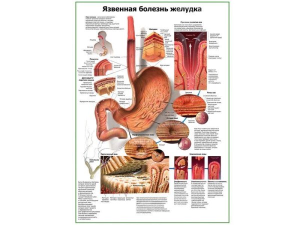 Язвенная болезнь желудка плакат