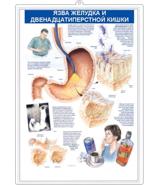 Памятка по профилактике язвенной болезни желудка