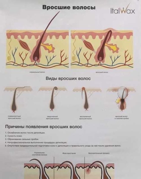 Врастание волос плакат
