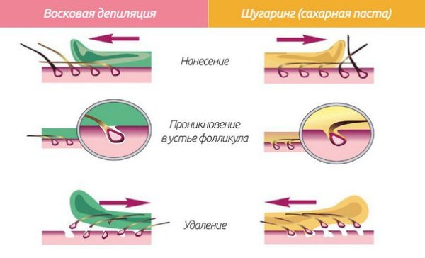 Зоны депиляции