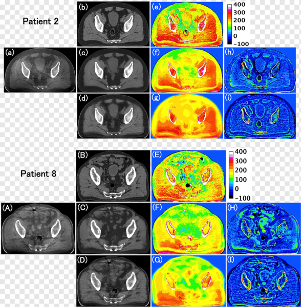 Расчет дозы от Cone Beam Computed tomography при лучевой терапии