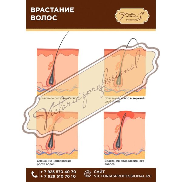 Типы вросших волос плакат