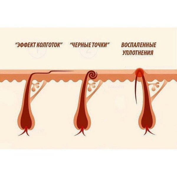 Типы вросших волос схема