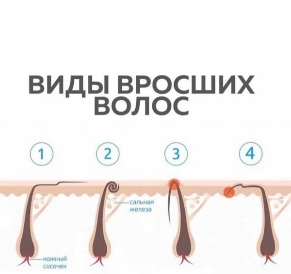 Плоский Колготочный Тип вросших волос