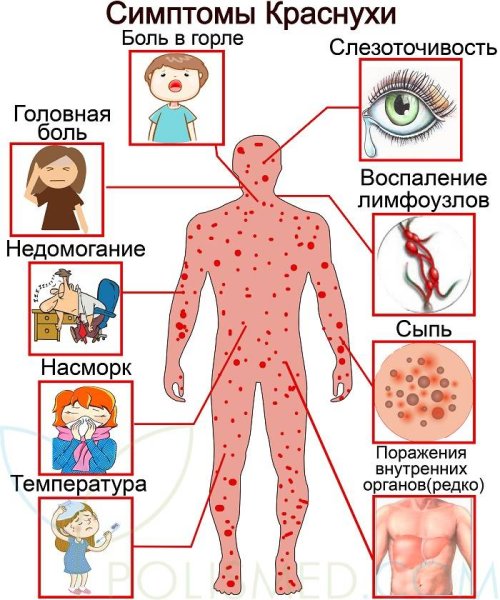 Ветряная оспа у детей памятка