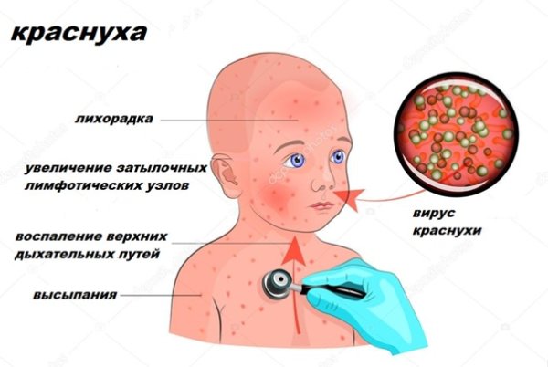 Ветрянка у детей симптомы