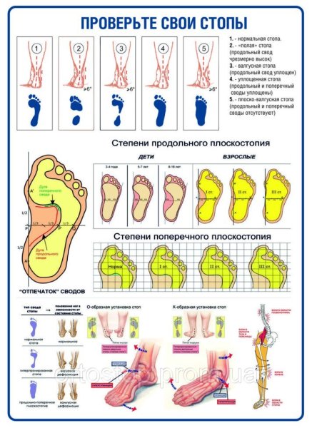 Плакат деформации стопы