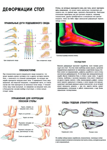 Плоскостопие. Причины, последствия, профилактика.