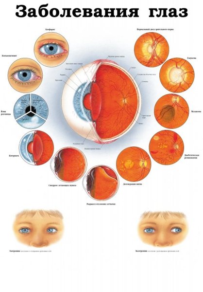 Болезни зрения плакат