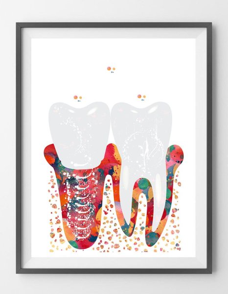 Имплантация зубов инфографика