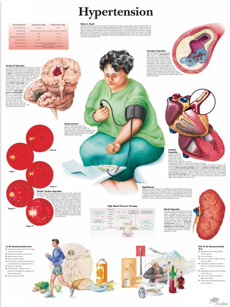 Артериальная гипертония плакат