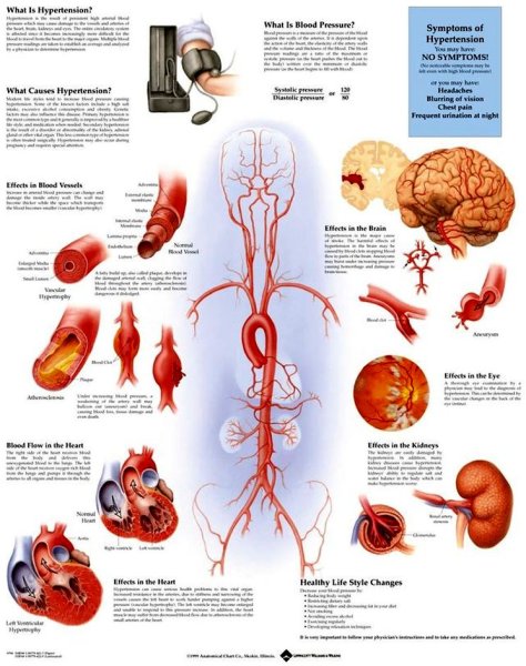 Артериальная гипертония плакат