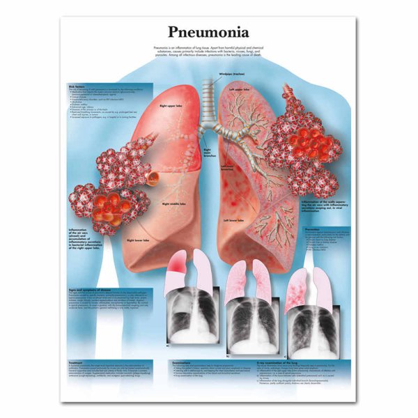 Медицинские плакаты пневмония