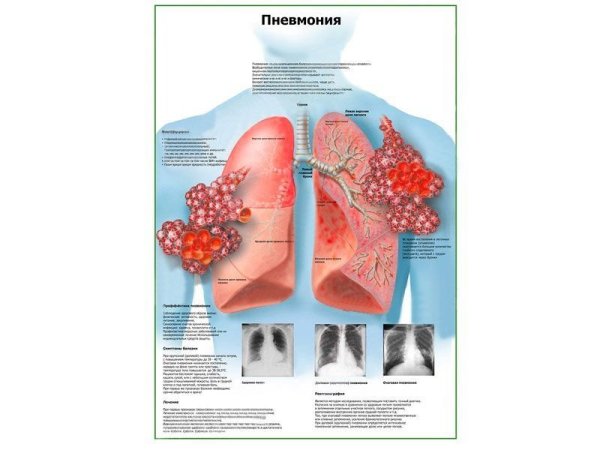 Плакаты по воспалению легких
