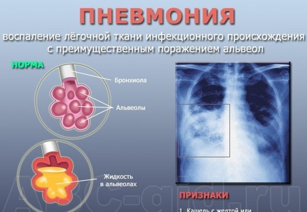 Брошюра профилактика пневмонии