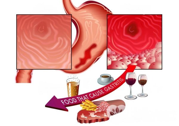 Санбюллетень по язвенной болезни желудка