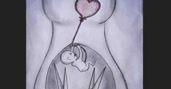 Схематичное изображение аборта