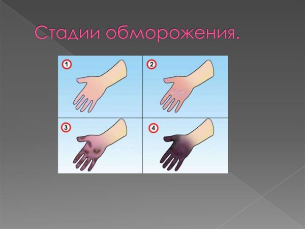 Отморожения презентация
