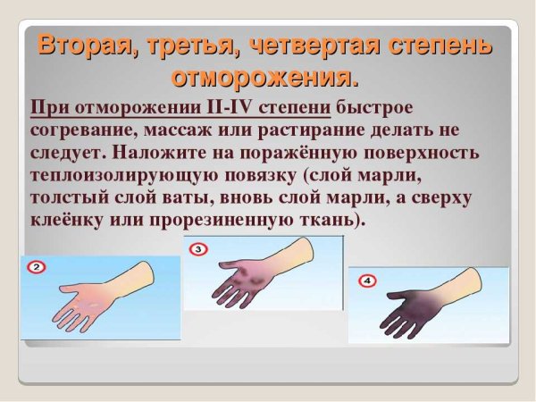 Ожоги и обморожения презентация