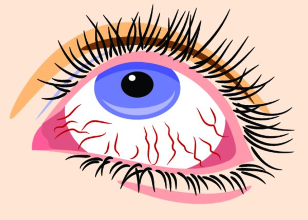 Рисунок воспаленного глаза