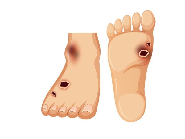 Кольца антимозольные арт.165