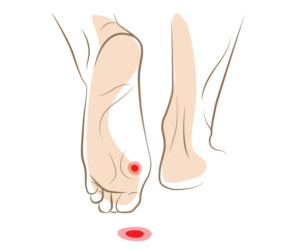 Как выглядит грибок на ногтях но ОГ